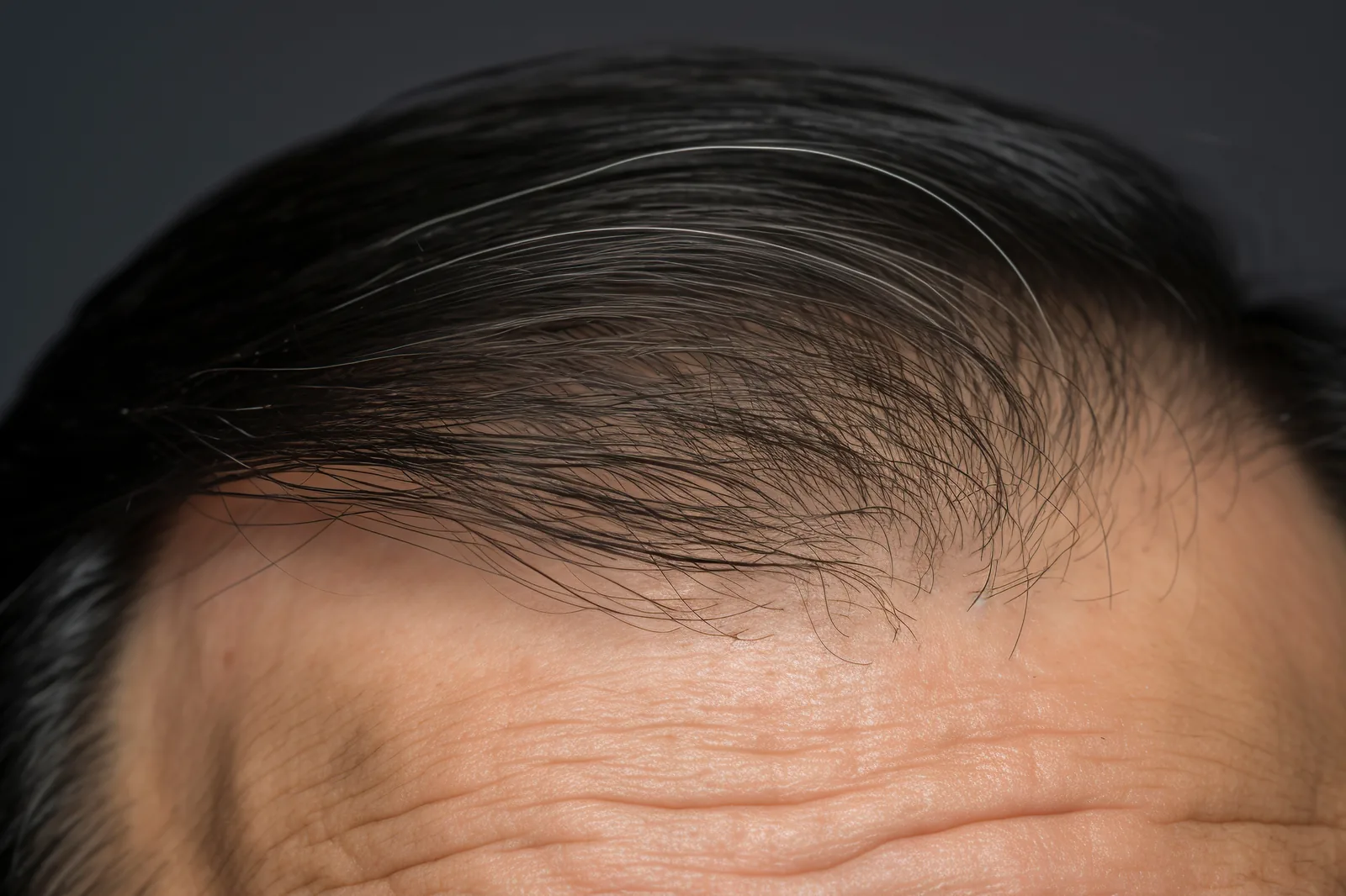 Close-up of hairline for hair restoration